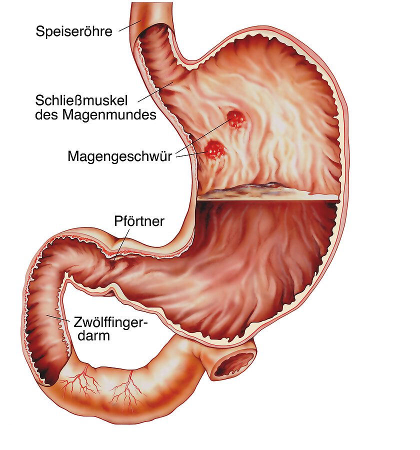 Gastritis Behandlung Wien Niederoesterreich