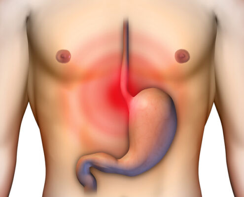 Heartburn - Reflux, Sodbrennen - Refluxösophagitis